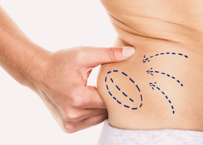 Liposuction: An Overview of Procedure, Benefits, Risks, and Recovery