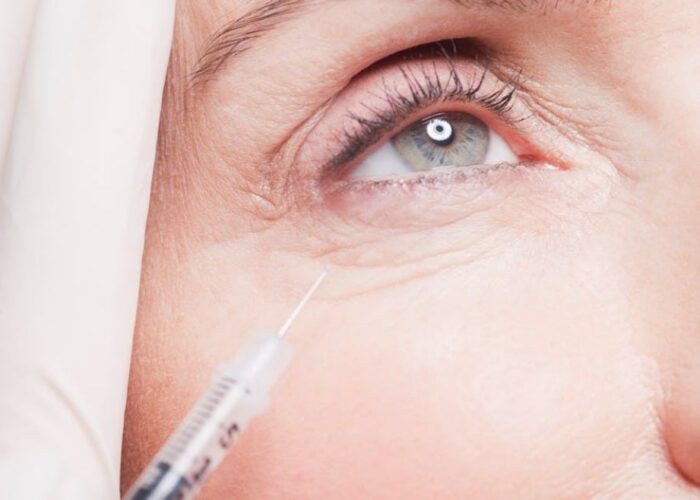 Eyebag Removal: Effective Treatments for a Fresher Look