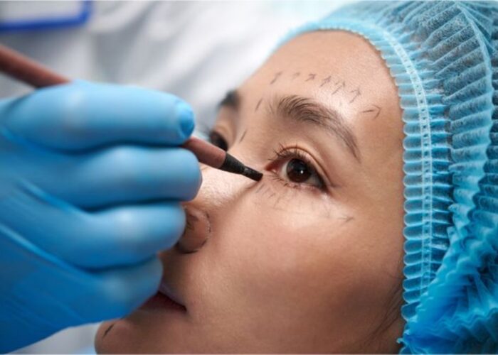 Everything You Should Know Before Getting Eyebag Removal Surgery