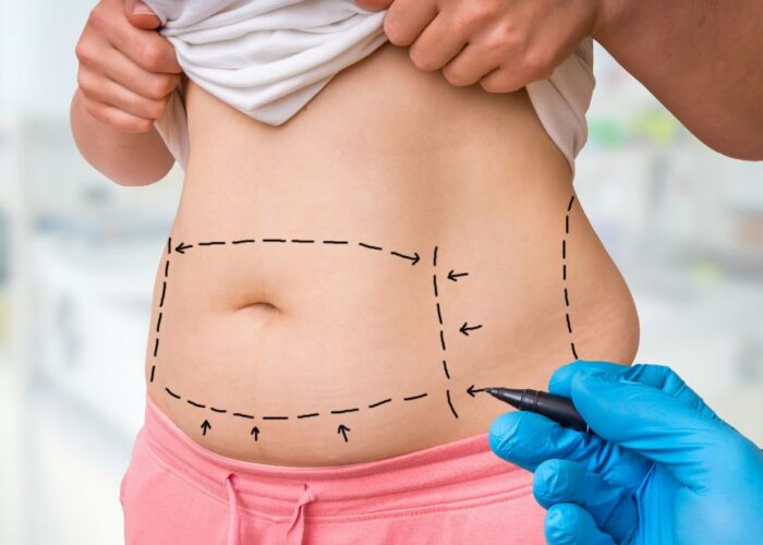 How Liposuction Surgery Works and Who It Is For