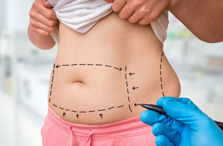 Liposuction Surgery