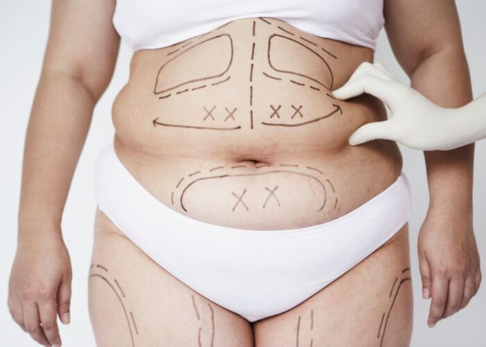 Preparing for Cosmetic Surgery Tummy Tuck: A Complete Patient Guide