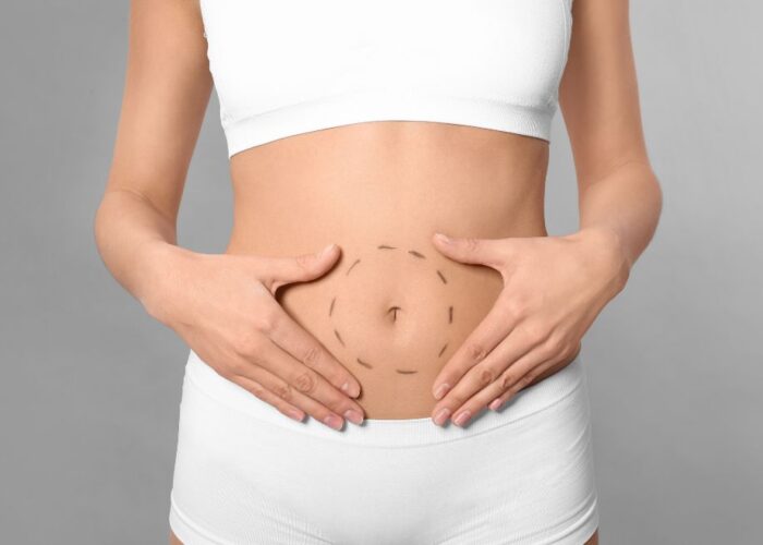 5 Things to Consider Before Choosing a Tummy Tuck in Malaysia