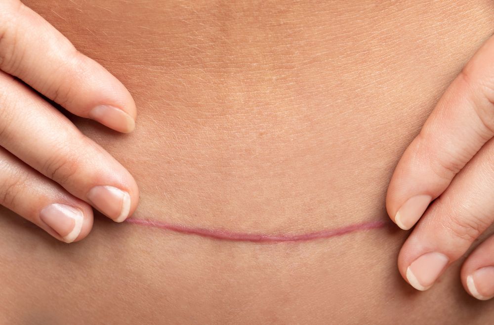 Tummy tuck Malaysia