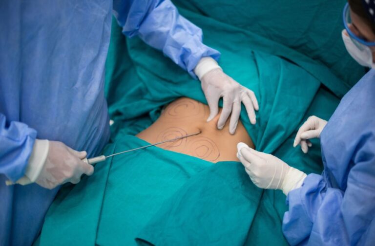 Cosmetic surgery Malaysia: Liposuction