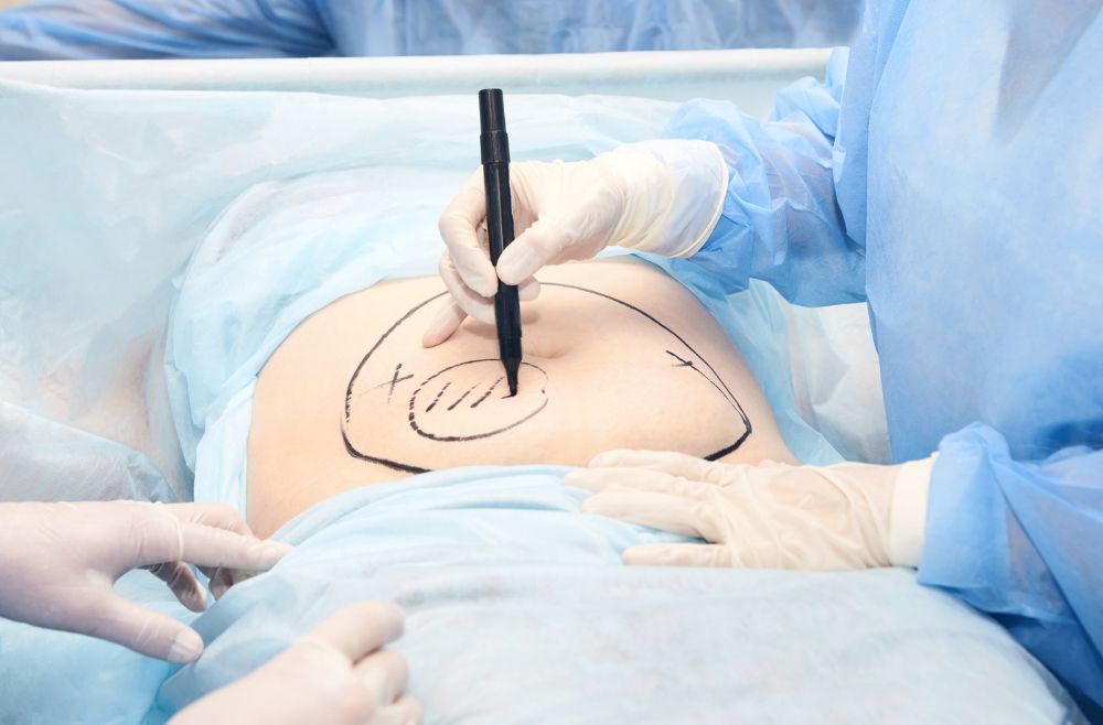 Cosmetic surgery Malaysia: Liposuction