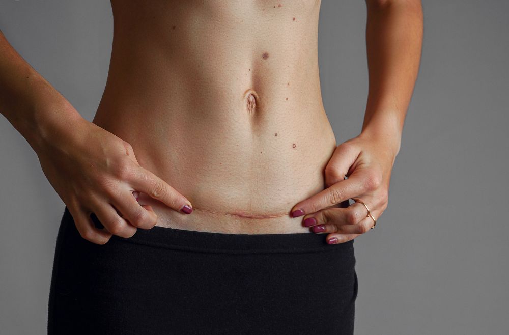 Tummy Tuck
