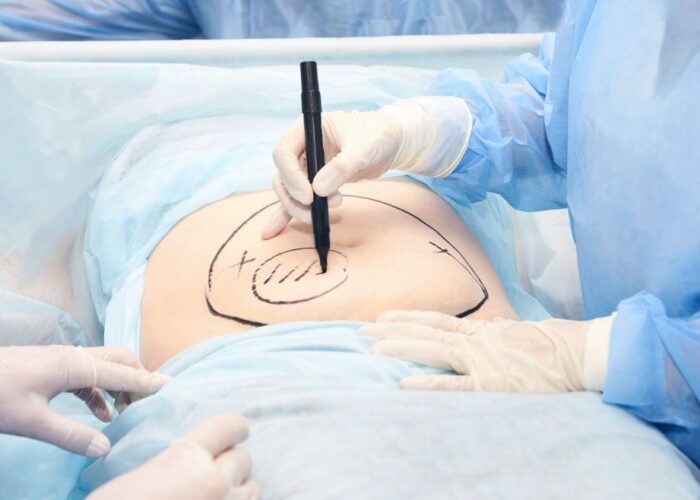 Liposuction Malaysia: A Guide to the Procedure and Recovery